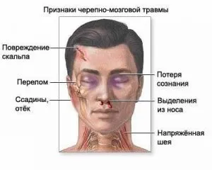 Перелом склепіння черепа причини, симптоми і лікування (лікування) Перелом склепіння черепа причини, симптоми і лікування