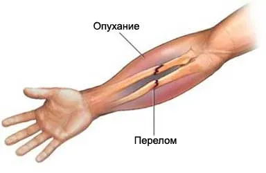 Перелом передпліччя симптоми, лікування, реабілітація (Переломи кісток передпліччя) Перелом передпліччя симптоми, лікування, реабілітація