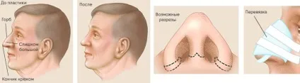 Перелом носа ринопластика або пластика зламаного, викривленого носа, виправлення після давньої (виправлення носа після перелому) Перелом носа ринопластика або пластика зламаного, викривленого носа, виправлення після давньої