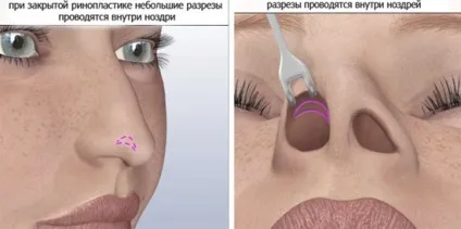 Перелом носа ринопластика або пластика зламаного, викривленого носа, виправлення після давньої (пластика) Перелом носа ринопластика або пластика зламаного, викривленого носа, виправлення після давньої