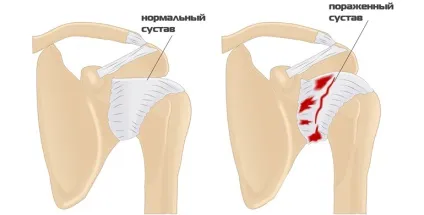 Периартроз плечового суглоба - лікування, симптоми, причини
