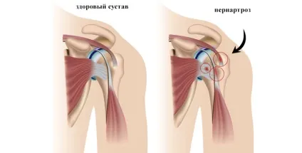 Периартроз плечового суглоба - лікування, симптоми, причини