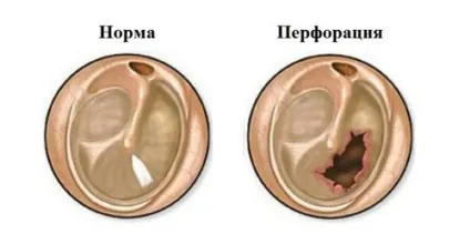 Перфорація барабанної перетинки симптоми і лікування (лікування) Перфорація барабанної перетинки симптоми і лікування