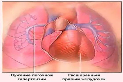Перевантаження правого передсердя що це таке, симптоми і лікування (таке) Перевантаження правого передсердя що це таке, симптоми і лікування