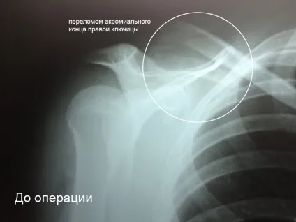 Перелом ключиці зі зміщенням період відновлення, операція з пластиною