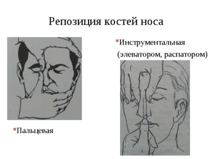 Перелом носа ринопластика або пластика зламаного, викривленого носа, виправлення після давньої (пластика) Перелом носа ринопластика або пластика зламаного, викривленого носа, виправлення після давньої