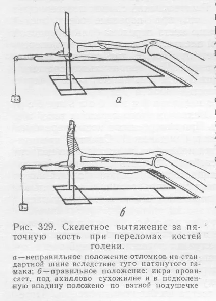 Перелом щиколотки коли можна наступати на ногу