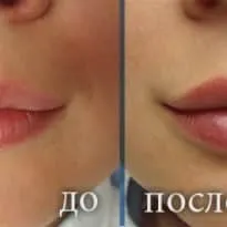 Перманентний макіяж губ фото до і після, наслідки (фото) Перманентний макіяж губ фото до і після, наслідки