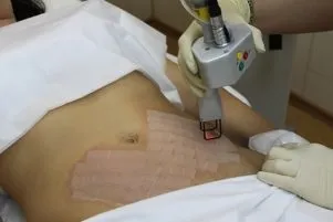 Пілінг розтяжок - про хімічний, лазерний і глибокий (розтяжок) Пілінг розтяжок - про хімічний, лазерний і глибокий