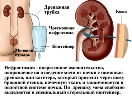 Перкутанная нефролітолапаксія і ендоскопія нирок що це таке (перкутанная) Перкутанная нефролітолапаксія і ендоскопія нирок що це таке