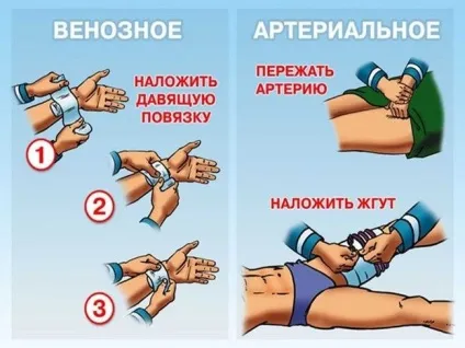 Перша допомога при венозній кровотечі - що важливо знати (перша) Перша допомога при венозній кровотечі - що важливо знати