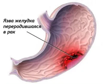 Перші ознаки раку шлунка на ранній стадії (ознаки) Перші ознаки раку шлунка на ранній стадії