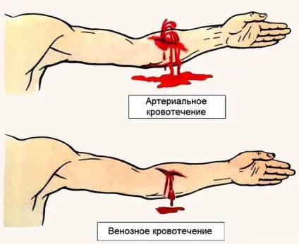 Перша допомога при венозній кровотечі - що важливо знати (перша) Перша допомога при венозній кровотечі - що важливо знати