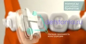 Пластикові брекети - як альтернатива іншим видам брекетів (брекетів) Пластикові брекети - як альтернатива іншим видам брекетів