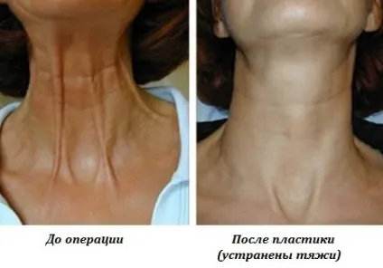 Платізмопластіка підтяжка шиї і підборіддя (підборіддя) Платізмопластіка підтяжка шиї і підборіддя