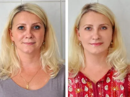 Платізмопластіка підтяжка шиї і підборіддя (країв підшкірної м'язи) Платізмопластіка підтяжка шиї і підборіддя