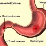 Чому болить живіт під ребрами найпоширеніші причини (поширені) Чому болить живіт під ребрами найпоширеніші причини