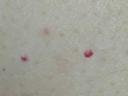 Чому з'являються родимки (чому) Чому з'являються родимки
