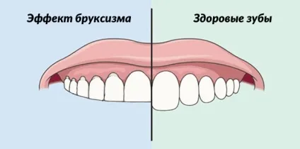 Чому уві сні скриплять зубами бруксизм у дорослих і його лікування (лікування) Чому уві сні скриплять зубами бруксизм у дорослих і його лікування