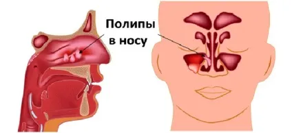 Поліпоз носа що це таке і лікування препаратами тканин пазух (поліпів пазух носа) Поліпоз носа що це таке і лікування препаратами тканин пазух