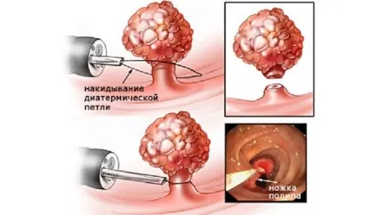 Поліпоз носа що це таке і лікування препаратами тканин пазух (пазух) Поліпоз носа що це таке і лікування препаратами тканин пазух