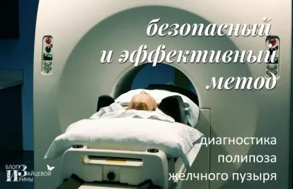 Поліпоз жовчного міхура (жовчного) Поліпоз жовчного міхура