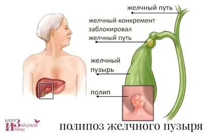 Поліпоз жовчного міхура (поліпоз) Поліпоз жовчного міхура
