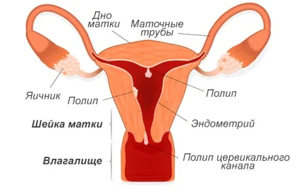 Поліп ендометрія матки (залозистий, фіброзний і ін