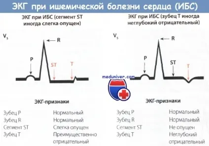 Показання та протипоказання для ЕКГ з фізичним навантаженням (фізичної) Показання та протипоказання для ЕКГ з фізичним навантаженням