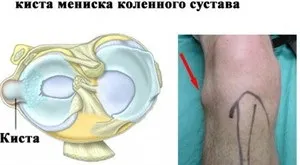 Пошкодження меніска колінного суглоба особливості патології, симптоми і методи лікування (пошкодження) Пошкодження меніска колінного суглоба особливості патології, симптоми і методи лікування