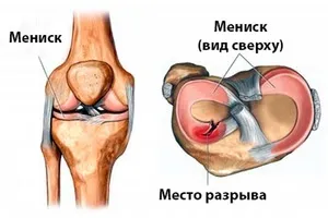Пошкодження меніска колінного суглоба особливості патології, симптоми і методи лікування (пошкодження) Пошкодження меніска колінного суглоба особливості патології, симптоми і методи лікування