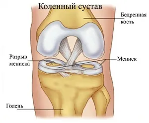 Пошкодження меніска колінного суглоба особливості патології, симптоми і методи лікування (меніска) Пошкодження меніска колінного суглоба особливості патології, симптоми і методи лікування