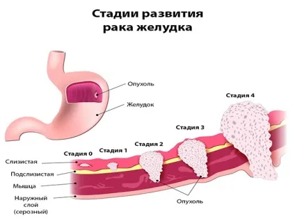 Постійна печія, причини що робити, часті напади печії (печія кожен день) Постійна печія, причини що робити, часті напади печії