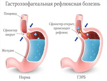 Постійна печія, причини що робити, часті напади печії (причини) Постійна печія, причини що робити, часті напади печії
