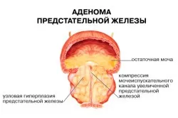 Передміхурова залоза функції, розташування і розміри простати (передміхурова залоза функції відповідає) Передміхурова залоза функції, розташування і розміри простати
