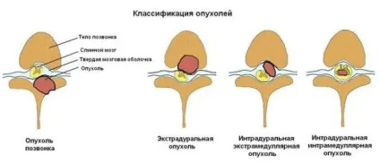 Пухлини спинного мозку симптоми, класифікація, лікування, діагностика раку (пухлини спинного мозку класифікація) Пухлини спинного мозку симптоми, класифікація, лікування, діагностика раку