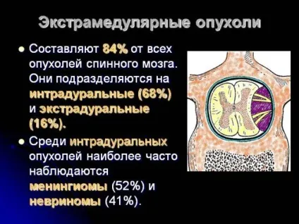 Пухлини спинного мозку симптоми, класифікація, лікування, діагностика раку (класифікація) Пухлини спинного мозку симптоми, класифікація, лікування, діагностика раку