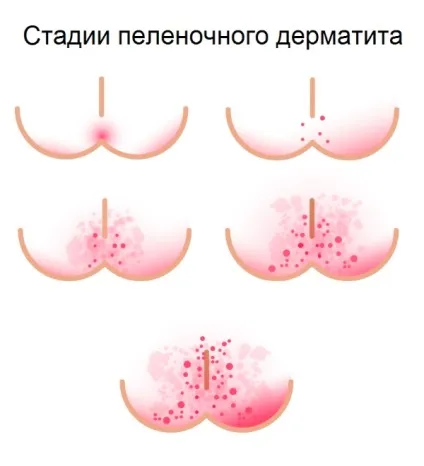 Попрілості у новонароджених фото і поради по лікуванню (новонароджених) Попрілості у новонароджених фото і поради по лікуванню