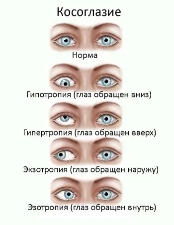 Причини косоокості у дітей та ефективні методи лікування (причини) Причини косоокості у дітей та ефективні методи лікування