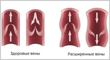 Причини появи варикозу на ногах і як їх усунути (причини) Причини появи варикозу на ногах і як їх усунути