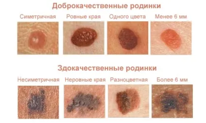 Причини появи червоних бородавок на тілі