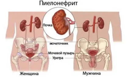 Причини появи простатиту у молодих чоловіків до 30 років
