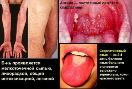 Прищі на мові ближче до горла червоні, білі, білястого відтінку, причини (мовою) Прищі на мові ближче до горла червоні, білі, білястого відтінку, причини
