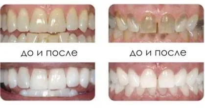 Професійне відбілювання зубів види, показання, особливості проведення гігієнічної процедури (відбілювання) Професійне відбілювання зубів види, показання, особливості проведення гігієнічної процедури