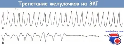 Ознаки тріпотіння і фібриляції шлуночків на ЕКГ (ознаки) Ознаки тріпотіння і фібриляції шлуночків на ЕКГ