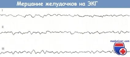 Ознаки тріпотіння і фібриляції шлуночків на ЕКГ (тріпотіння) Ознаки тріпотіння і фібриляції шлуночків на ЕКГ