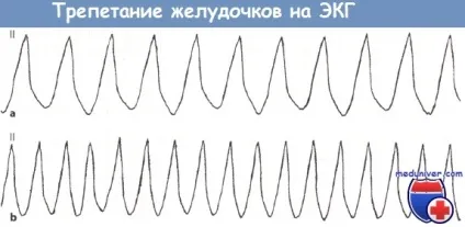 Ознаки тріпотіння і фібриляції шлуночків на ЕКГ (ознаки) Ознаки тріпотіння і фібриляції шлуночків на ЕКГ