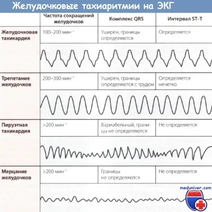 Ознаки тріпотіння і фібриляції шлуночків на ЕКГ (фібриляції) Ознаки тріпотіння і фібриляції шлуночків на ЕКГ