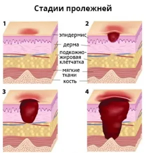 Пролежні причини, симптоми, лікування і профілактика (симптоми) Пролежні причини, симптоми, лікування і профілактика