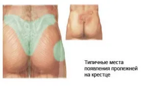 Пролежні - в чому небезпека їх освіти і як цього уникнути (загальна хірургія) Пролежні - в чому небезпека їх освіти і як цього уникнути